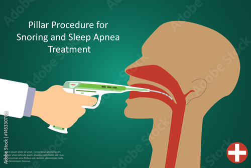 Vector illustration of procedures for sleep apnea pillar operation.