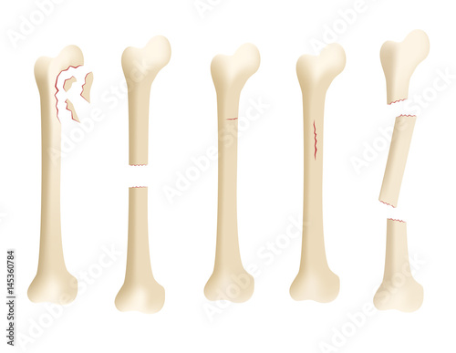 crack human bone vector