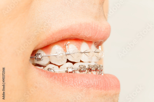 Profile view of braces for orthodontic treatment