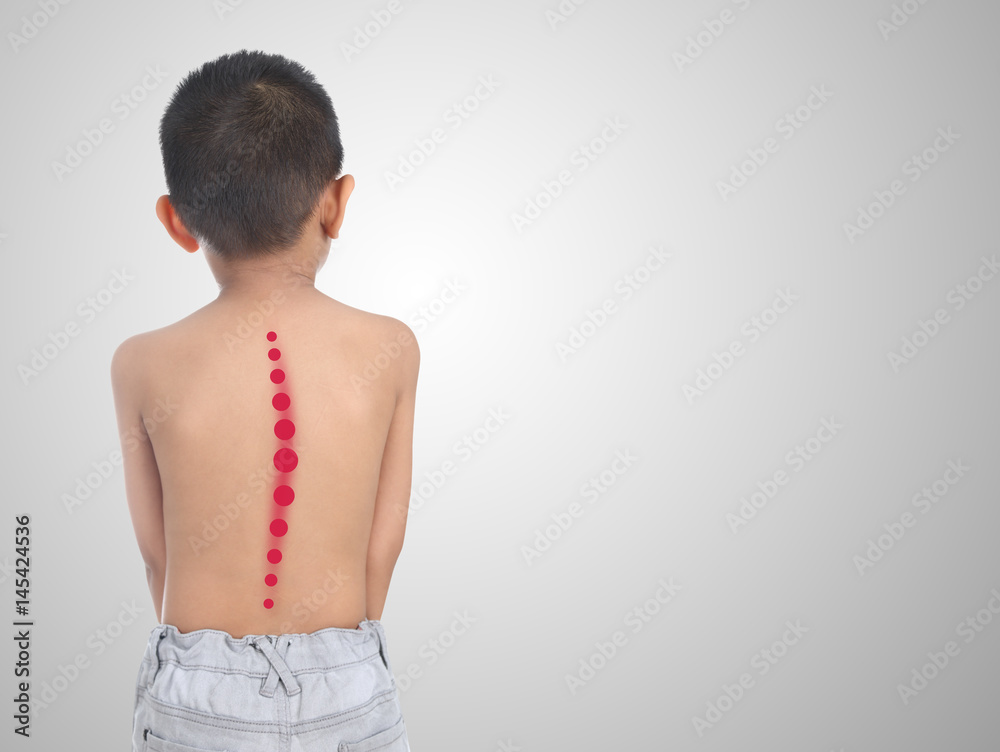 Asian kid with scoliosis, isolated on white background Asian kid with scoliosis, isolated on white background