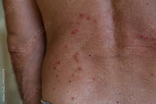 rash on back skin