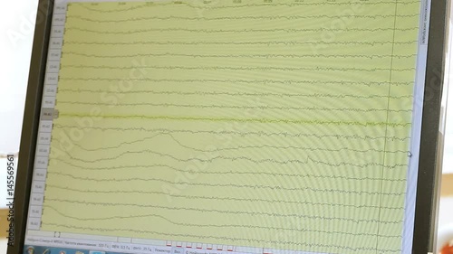 Electroencephalographic examination. Close-up shot of monitor screen with results of monitoring the functions of the human brain. HD
