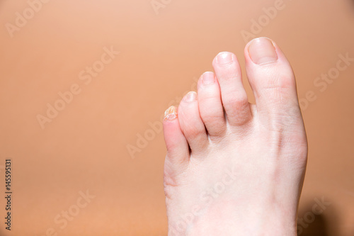 woman feet. splittet little nail. pain. disease