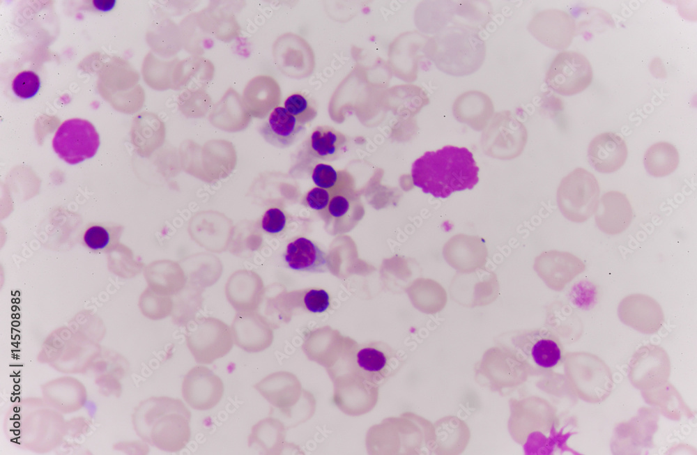 Abnormal red blood cells