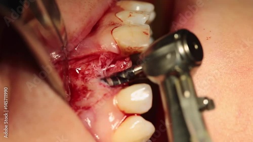 Preparation for an implant with a set of drills for an implant of the front tooth