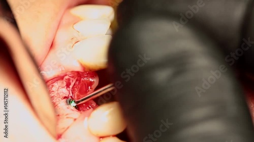 A twisted set of dental implant for the front tooth, a gum slit for bone extension