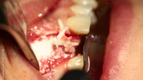 The gingival wall thickness of the bone wall in the jaw with the addition of natural bone