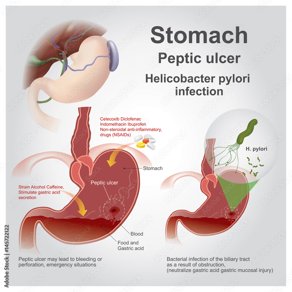 Naklejka premium stomach peptic ulcer