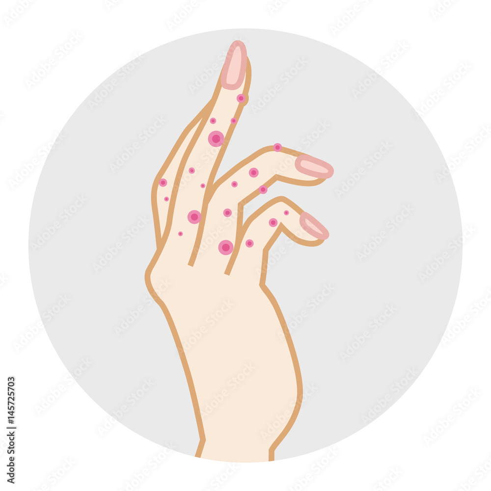 Obraz premium Eczema hand -Side view 手湿疹 側面