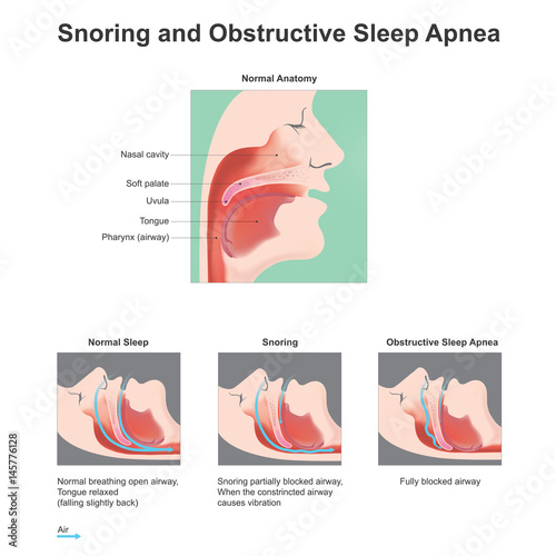 Snoring and obstructive Sleep Apne. Vector graphic.  