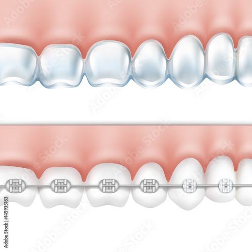 human teeth with braces set