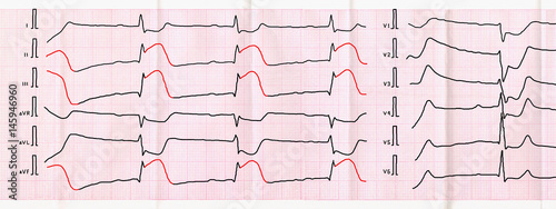 ECG tape with sharpest period of macrofocal posterior diaphragmatic myocardial infarction photo