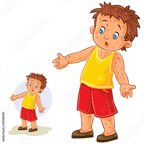 Vector illustration of a little boy with a rash on his hands and legs, chickenpox, smallpox, allergies. Print