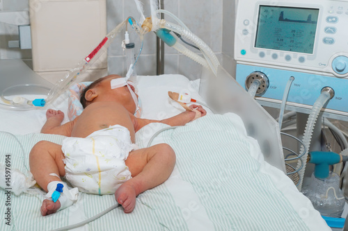Newborn baby with hyperbilirubinemia on breathing machine or ventilator with pulse oximeter sensor and peripheral intravenous catheter at children's hospital