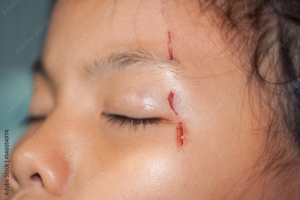 Fototapeta premium Close up of painful wound nearly the eye on children