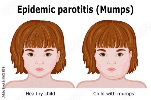 A child with symptoms of mumps photo