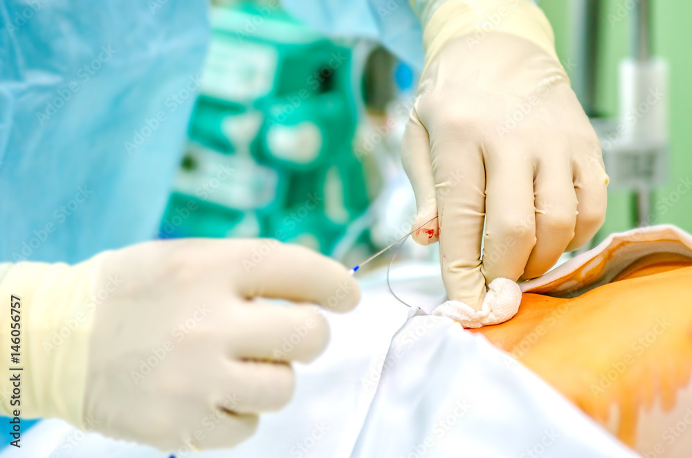 The process of setting the central catheter before the operation.