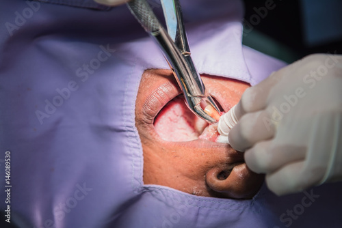 Caries tooth extraction by the dentist. Dentistry in hospital.  