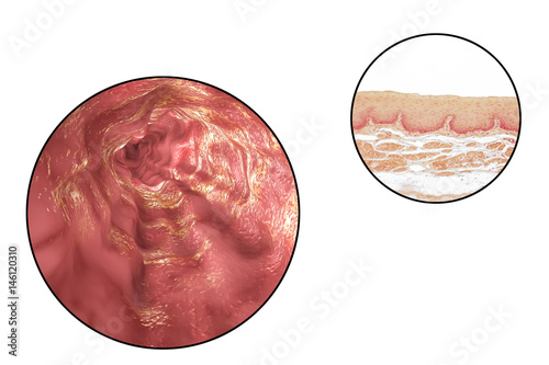 Human esophagous, 3D illustration and light micrograph of esophageal non-keratinized stratified squamous epithelium photo