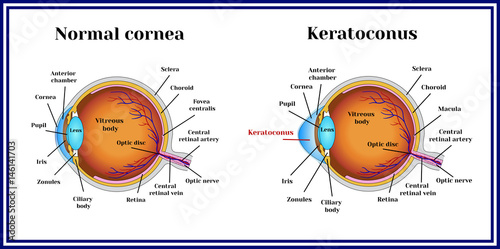 Keratoconus. Dystrophic disease of the cornea. photo