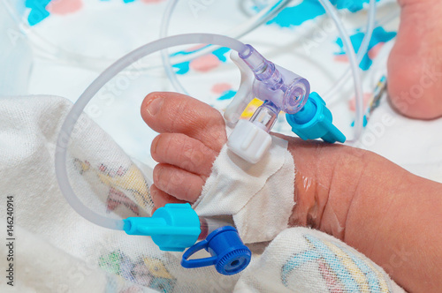 Peripheral intravenous catheter in the vein of newborn baby foot