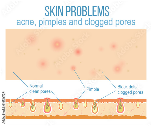 Skin problems such as acne, pimples and clogged pores. Top view of skin and side view of pores. Vector.