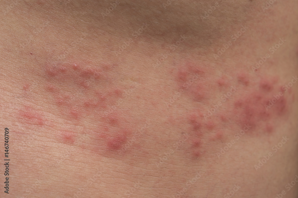 Closeup of body skin with Herpes Zoster (Shingles)