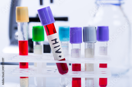 Картината върху платно tubes with hiv test blood samples in laboratory