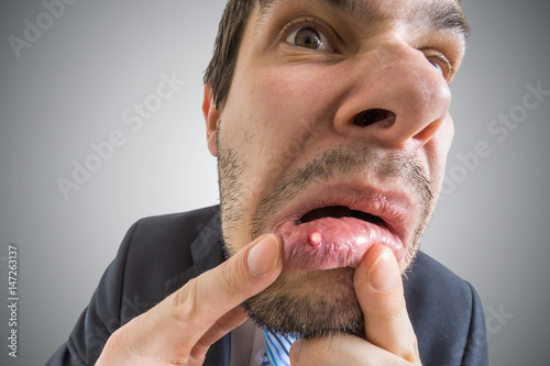 Young man is looking on ulcer or blister in his mouth in mirror. photo