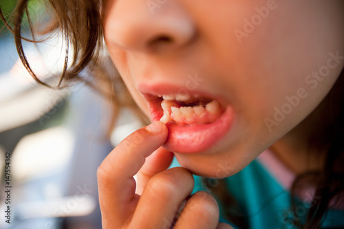 Girl touching loose tooth photo