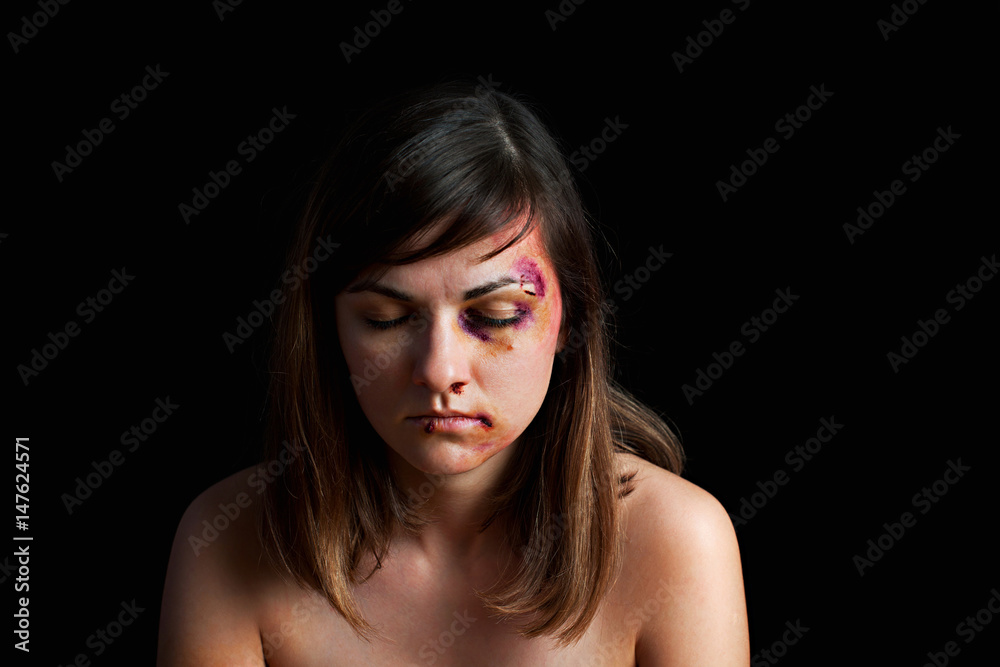 Beaten young woman with bruises on her face. Abuse, violence concept Stock Photo Adobe Stock