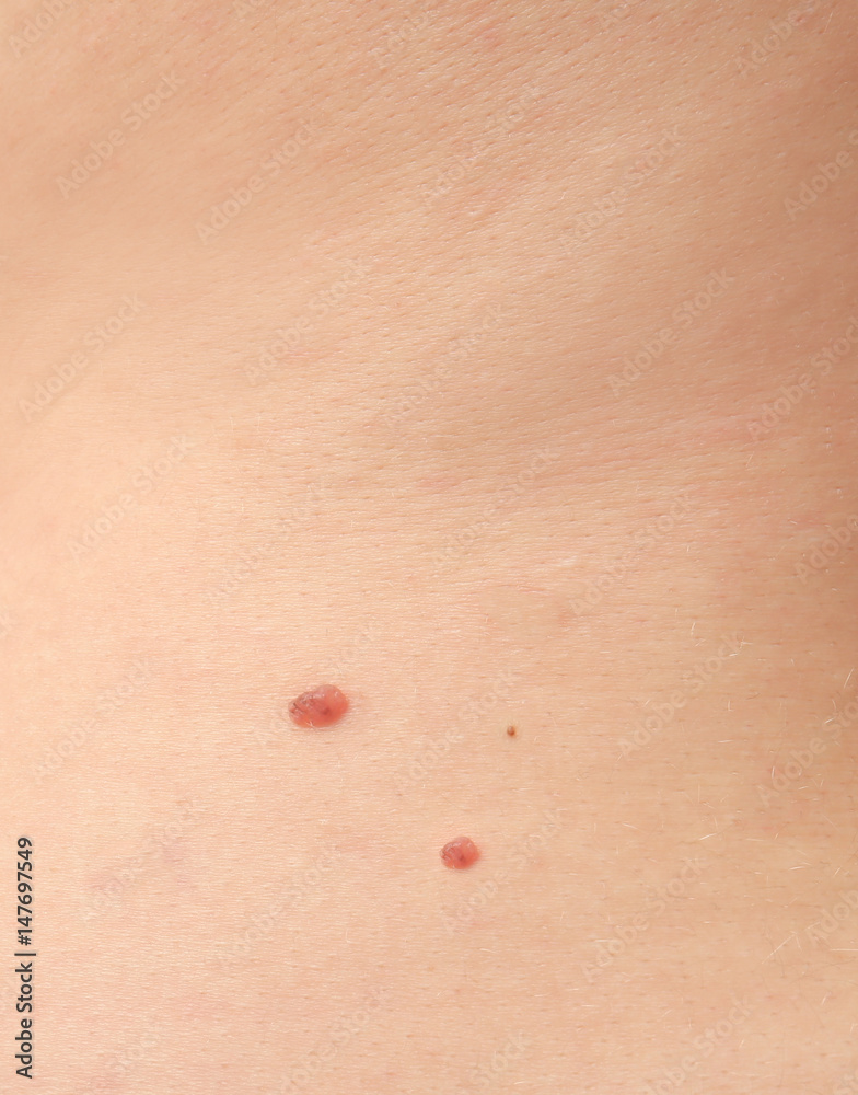 Back of woman with birthmark, closeup Back of woman with birthmark, closeup