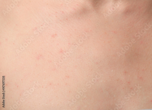Human skin with pimples, closeup