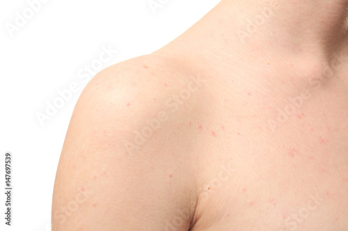 Young woman with problem skin on white background, closeup