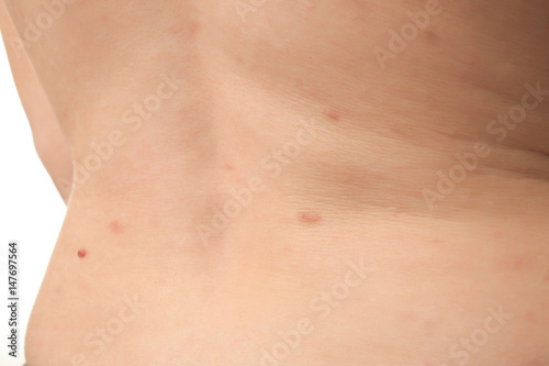Back of woman with birthmark, closeup