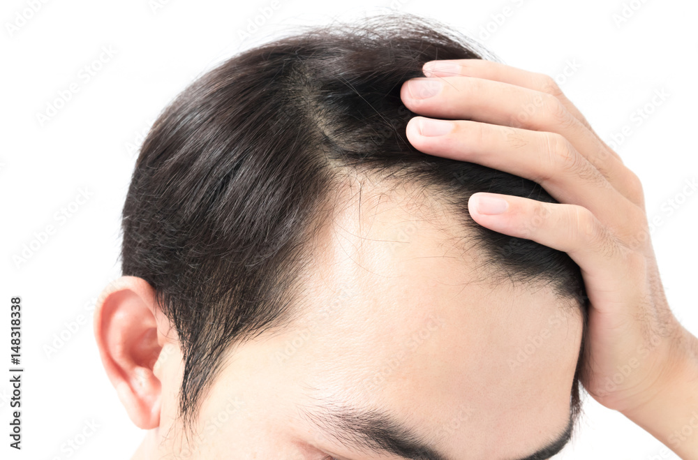 Fototapeta premium Young man serious hair loss problem for health care shampoo and beauty product concept