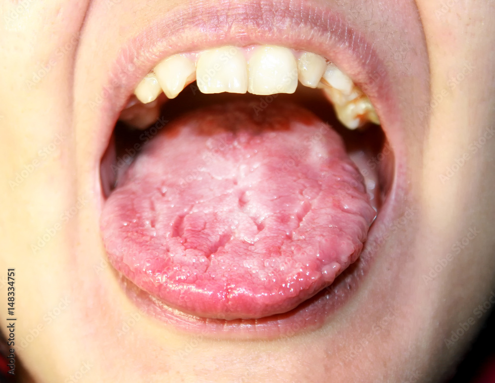 Obraz premium The tongue is in a white raid. Candidiasis in the tongue