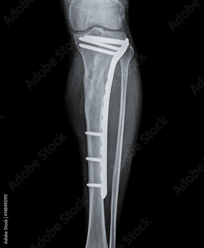X ray of fractured tibia bone with fibula. photo