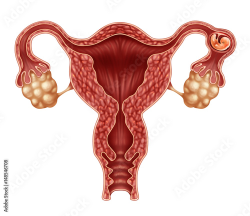 Ectopic Pregnancy photo
