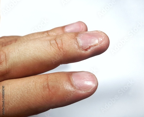 Defect finger due to injury