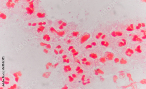 Moderate red white blood cells with gram negative diplococci.