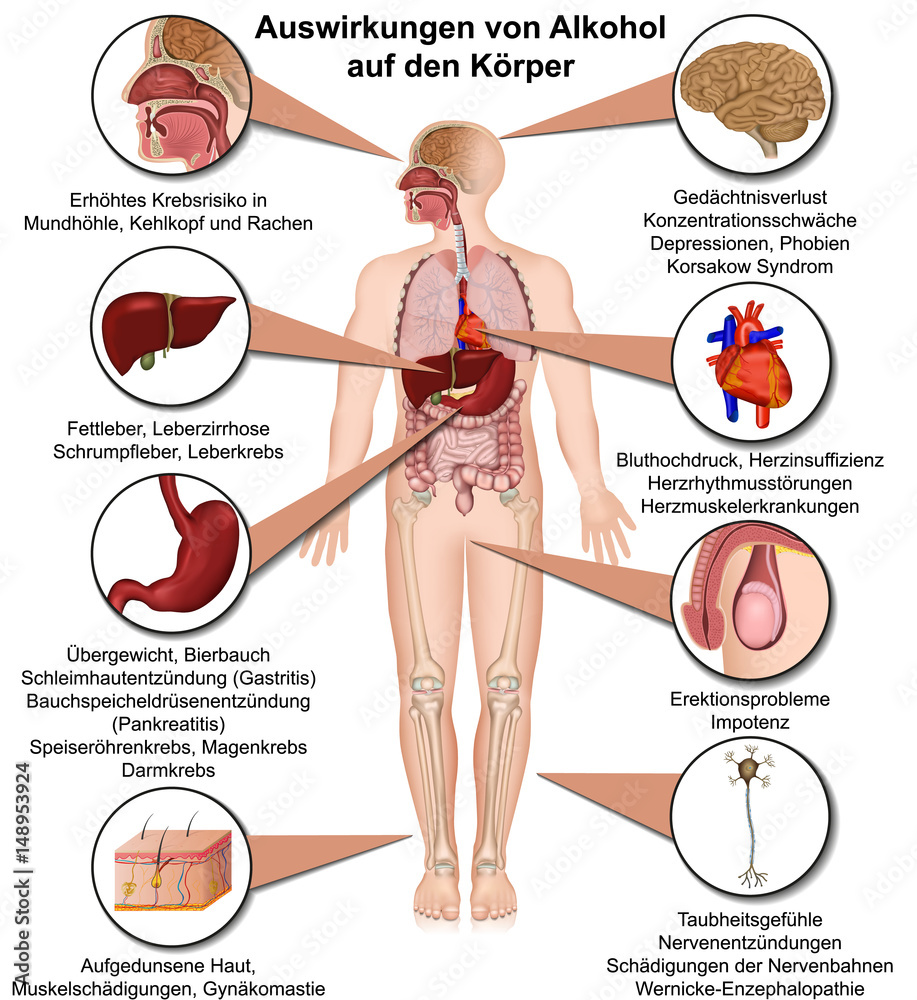 Auswirkungen von Alkohol auf den Körper, Alkoholmissbrauch Infografik - obrazy, fototapety, plakaty 