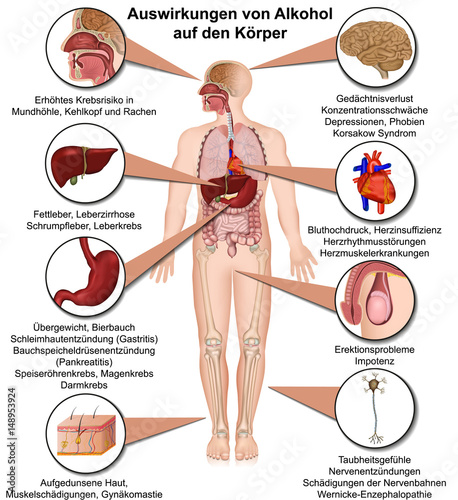 Auswirkungen von Alkohol auf den Körper, Alkoholmissbrauch Infografik photo