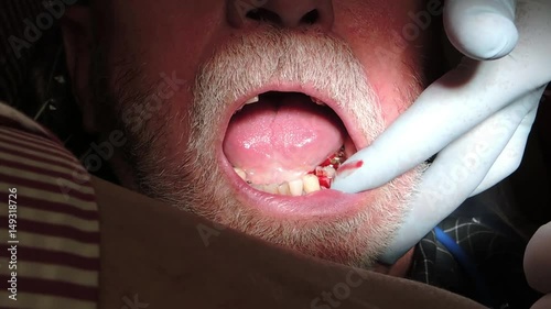 Close up, dentist pulls out man's tooth photo