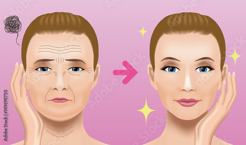 Facial wrinkles treatment before after. cosmetic surgery. woman facial treatment concept.