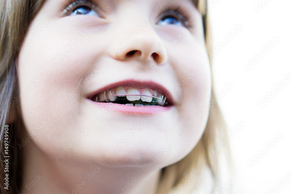 Glückliches Kind mit Zahnspange Glückliches Kind mit Zahnspange