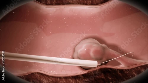 A polyp is a fleshy outgrowth from the inner lining of the colon or rectum. http://www.polymime.com