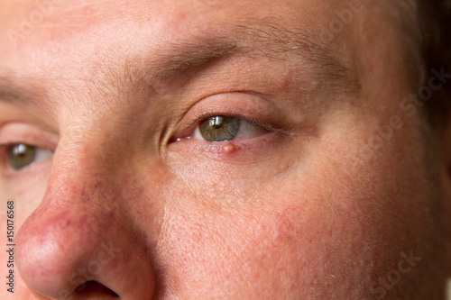Big pimple on the skin of the lower eyelid on the man's face.