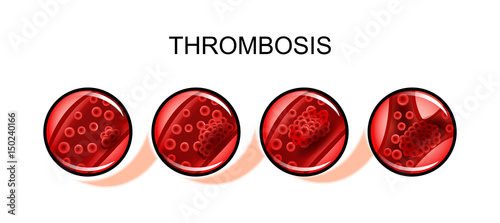 thromboembolism artery. blockage photo