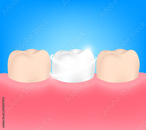 Dental veneers on a human tooth.  Before and After, whitening oral care concept. Deep cleaning, clearing tooth process.  illustration on blue background.